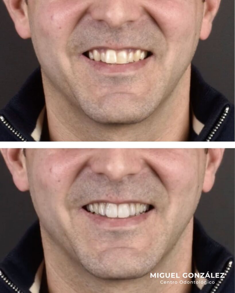 Antes y después de un caso de diseño de sonrisa digital en Oviedo en un paciente adulto, con bordes más uniformes