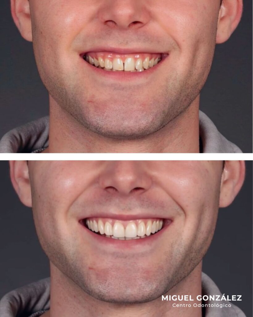 Sonrisa de un paciente antes y después de un tratamiento estético planificado en digital en Oviedo
