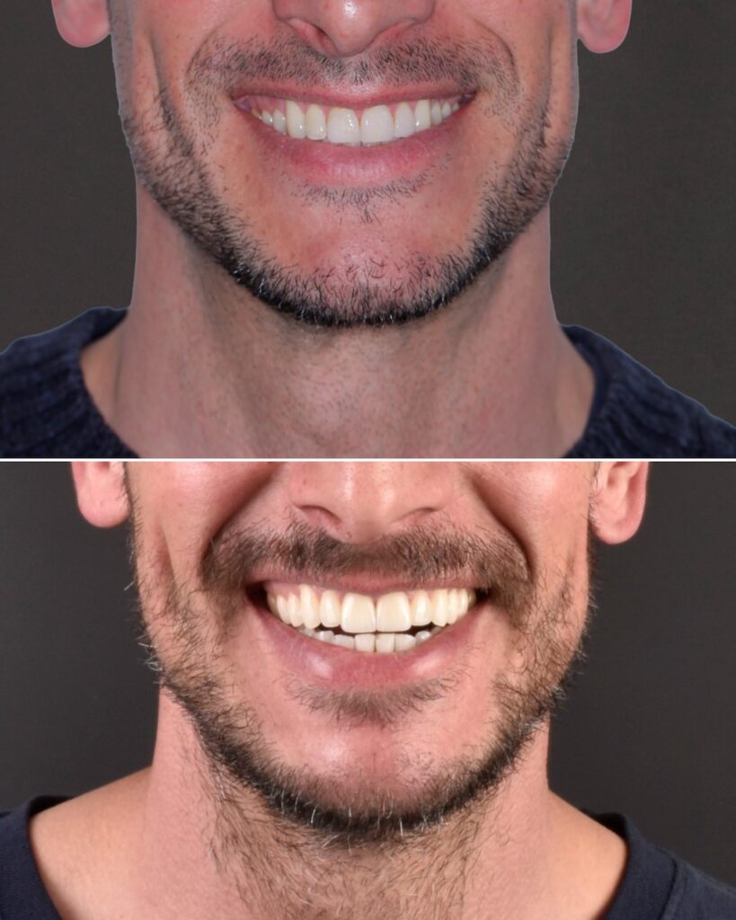 Antes y después de carillas dentales en Oviedo: la sonrisa gana anchura y un tono más natural.