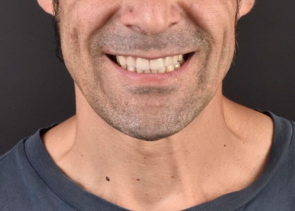 Después de Carillas dentales en Oviedo - Clínica Dental Miguel González 1