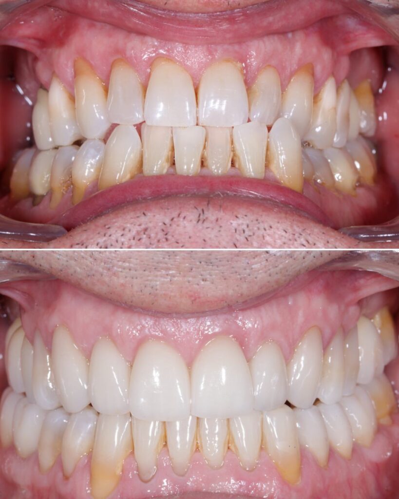 Antes-despues-Blanqueamiento-dental-en-Oviedo-con-un-plan-a-tu-medida-Centro-Odontologico-Miguel-Gonzalez-1