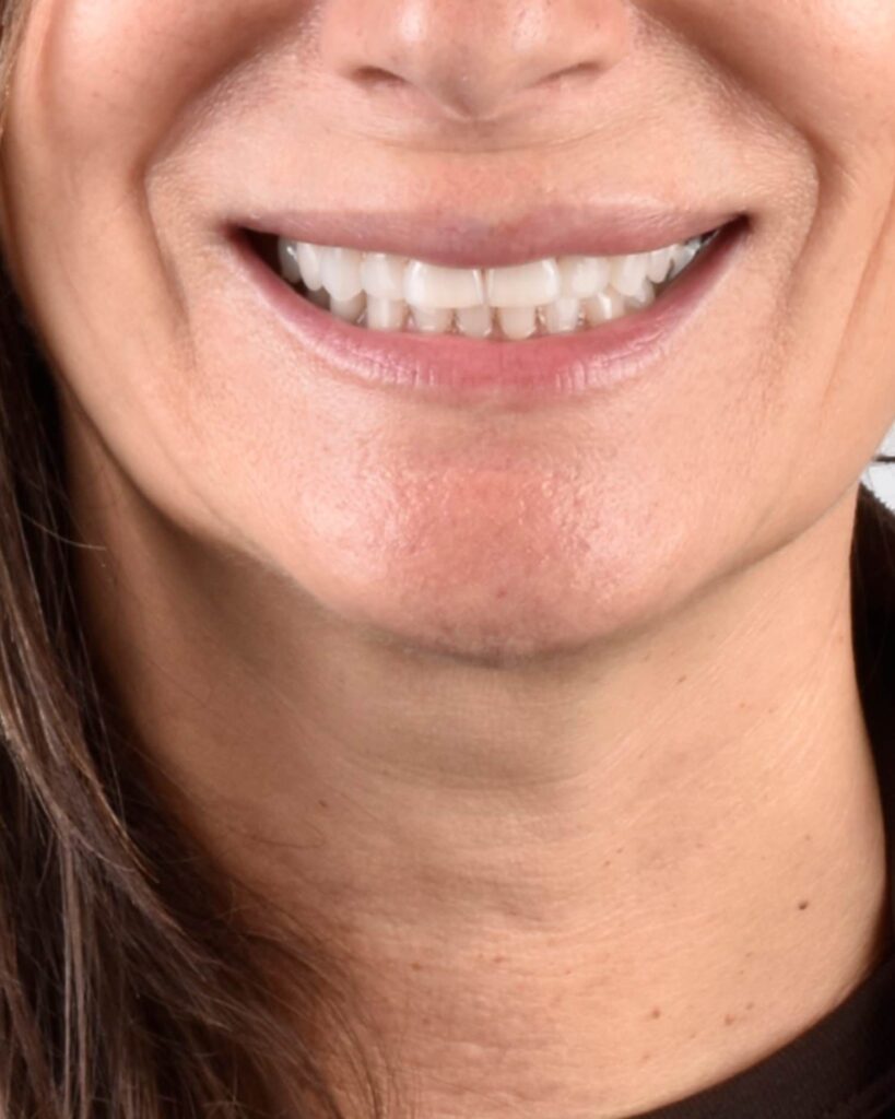 Blanqueamiento-dental-en-Oviedo-con-un-plan-a-tu-medida-Centro-Odontologico-Miguel-Gonzalez-2