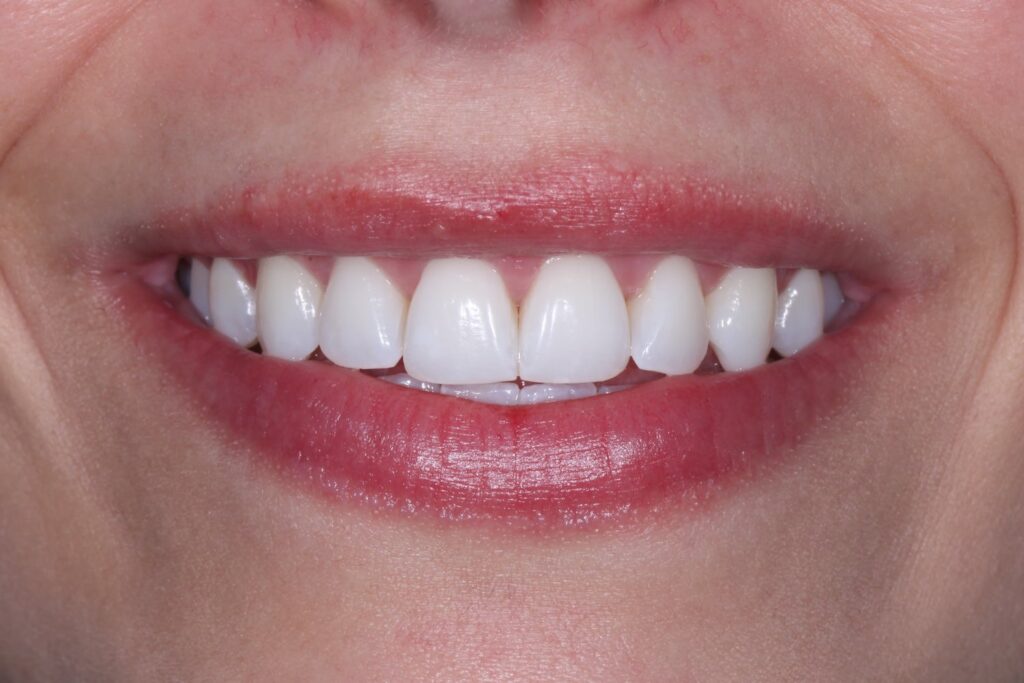 Blanqueamiento dental en Oviedo con un plan a tu medida - Centro Odontológico Miguel González 5